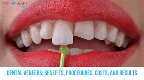 resin veneers|Dental Veneers: Benefits, Procedure, Costs, and Results.